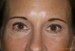 Female Eyelid Surgery