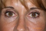 Female Eyelid Surgery