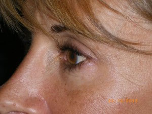 Female Eyelid Surgery