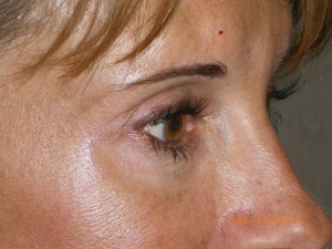 Female Eyelid Surgery