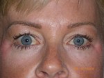 Female Eyelid Surgery