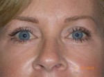 Female Eyelid Surgery