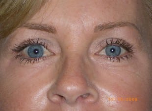 Patient 121 - After View 