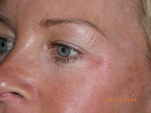 Female Eyelid Surgery
