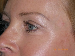 Female Eyelid Surgery