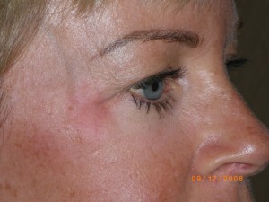 Female Eyelid Surgery