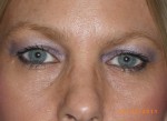 Female Eyelid Surgery