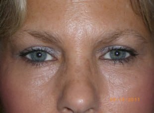 Patient 135 - After View 