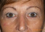 Female Eyelid Surgery