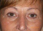 Female Eyelid Surgery