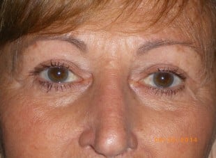 Patient 137 - After View 