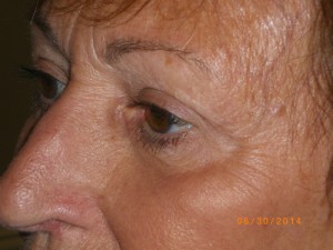 Female Eyelid Surgery