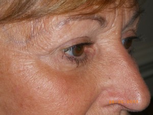 Female Eyelid Surgery