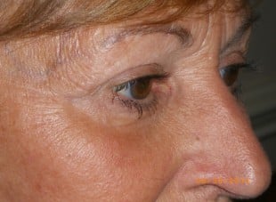Patient 137 - After View 