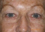 Female Eyelid Surgery