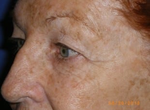 Patient 139 - Before View 