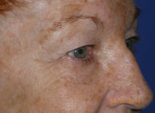 Patient 139 - Before View 