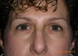 Female Eyelid Surgery