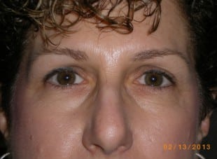 Patient 140 - Before View 