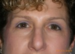 Female Eyelid Surgery