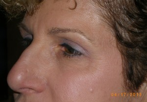 Female Eyelid Surgery