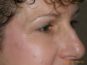 Female Eyelid Surgery