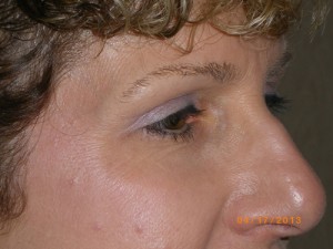 Female Eyelid Surgery