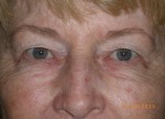 Female Eyelid Surgery