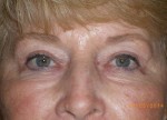 Female Eyelid Surgery