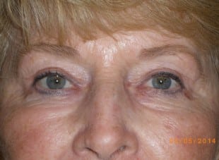 Patient 141 - After View 