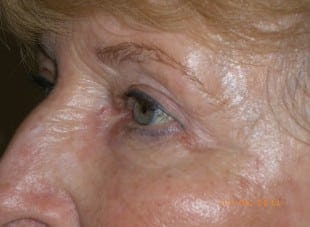Patient 141 - After View 