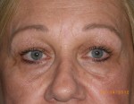 Female Eyelid Surgery