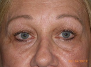 Patient 142 - Before View 