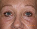 Female Eyelid Surgery