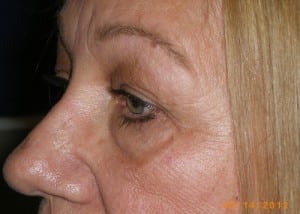 Female Eyelid Surgery