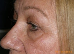 Patient 142 - Before View 