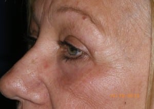 Female Eyelid Surgery