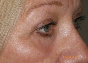 Female Eyelid Surgery