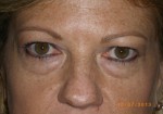 Female Eyelid Surgery