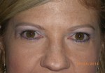 Female Eyelid Surgery