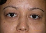 Female Eyelid Surgery