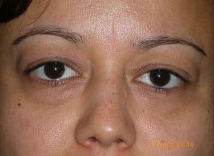 Patient 144 - Before View 