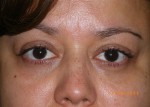 Female Eyelid Surgery