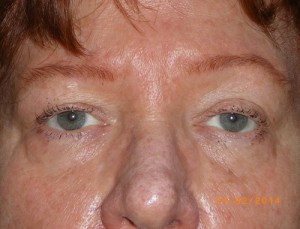 Female Eyelid Surgery