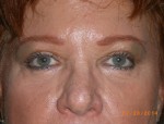 Female Eyelid Surgery