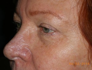 Female Eyelid Surgery