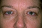 Female Eyelid Surgery