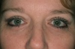 Female Eyelid Surgery