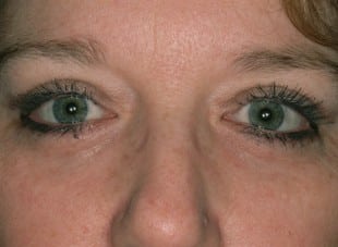 Patient 146 - After View 