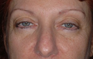 Female Eyelid Surgery